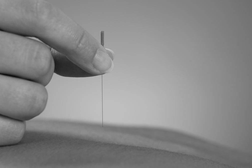 dry needling