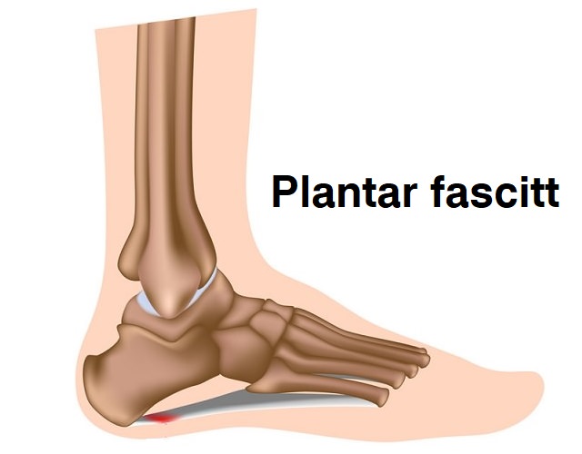 Illustrasjon av plantar fascitt, markert der smerten er mest intens under foten