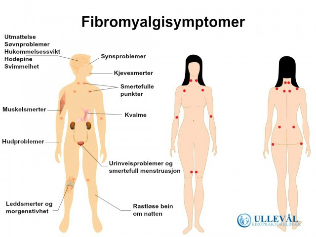 Fibromyalgi symptomer oversikt