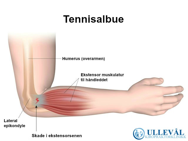 Prednisolon tennisalbue