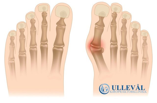 illustrasjon av hallux valgus