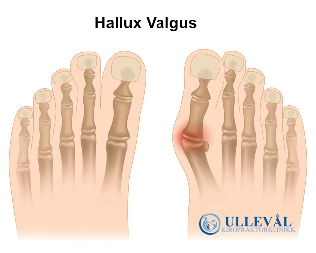 anatomi av hallux valgus ullevål kiropraktor