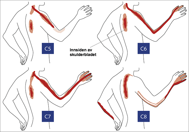 Hvor lenge varer prolaps i nakken