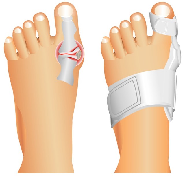 taping av hallux valgus