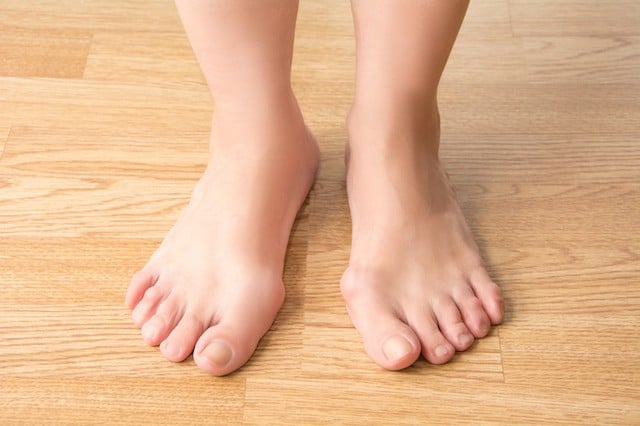 Unngå hallux valgus med disse øvelsene | Ullevål Unngå hallux valgus med disse øvelsene | Ullevål