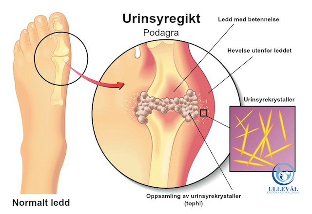 urinsyregikt og podagra urinsyrekrystaller