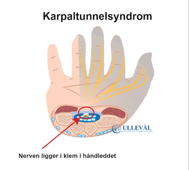 karpaltunnelsyndrom med en nerve i klem