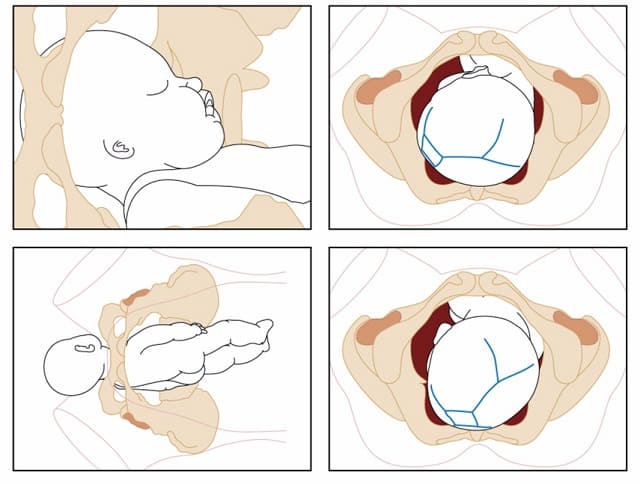 vaginal fødsel bekken