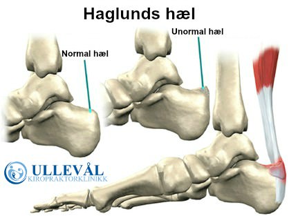 En trofast ankomme mineral Haglunds hæl | Ullevål Kiropraktorklinikk