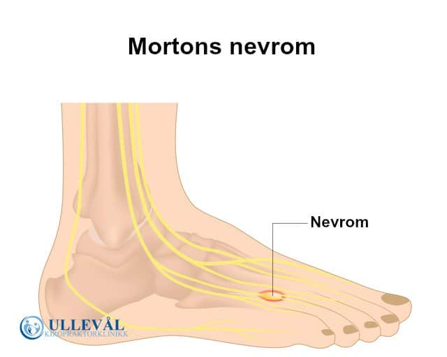 vondt under fortfoten og tærne mortons nevrom