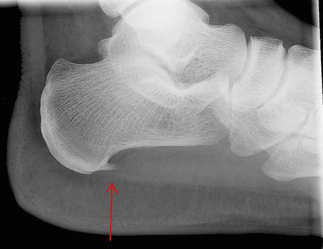 røntgenbilde av en fot med en pil mot hælspore