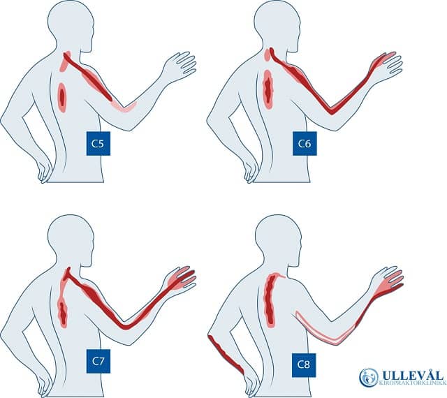 Image: Hva er nakkeprolaps?