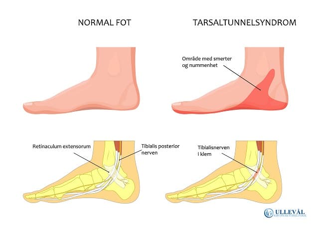 smerter under foten fra nerve i klem i ankelen