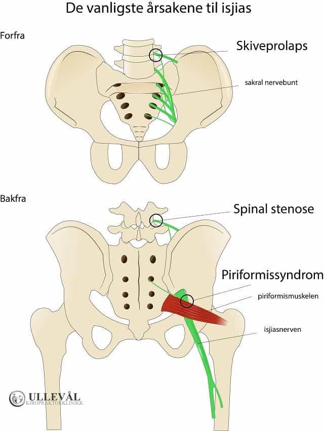 årsaker til isjias - skiveprolaps, spinal stenose og piriformissyndrom