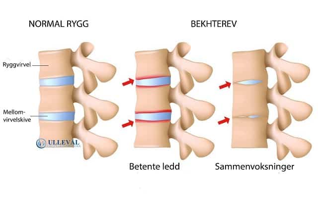 senebetennelse legg