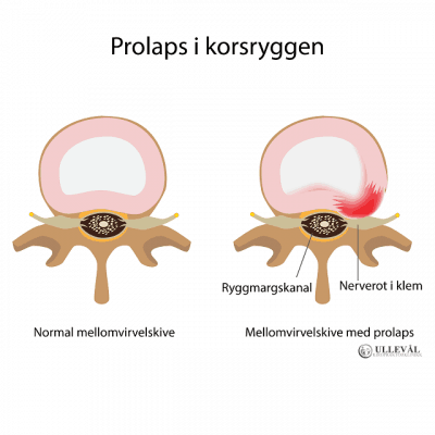 Image: Alt du bør vite om prolaps i korsryggen