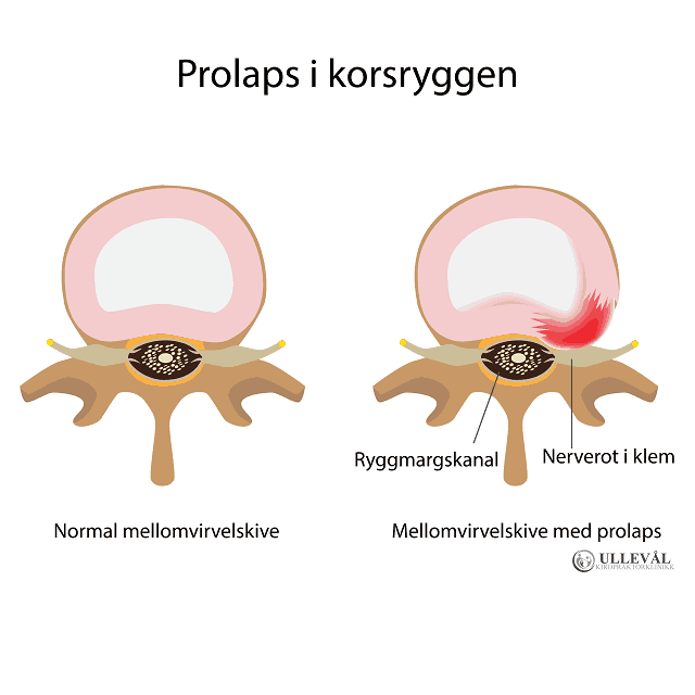 prolaps i korsryggen