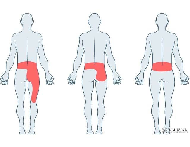 Smerter i korsryggen og hofter