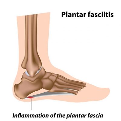 Image: Øvelser for plantar fascitt