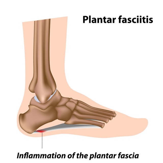 plantar fascitt illustrasjon