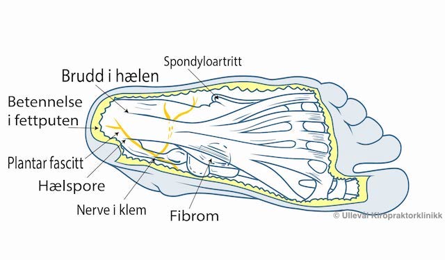 Bilde av typiske smerteområder under foten