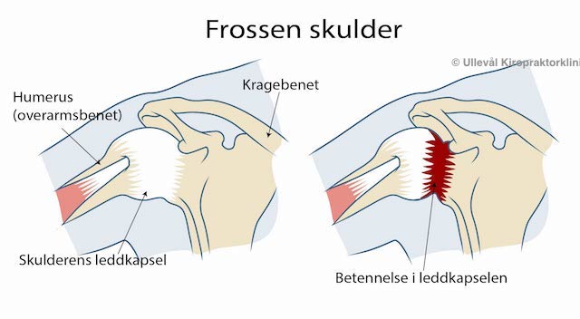 illustrasjon av utvikling av frossen skulder