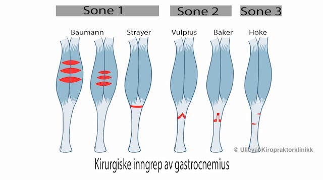 Illustrasjon av kirurgiske ingnrep gjort i leggmuskel