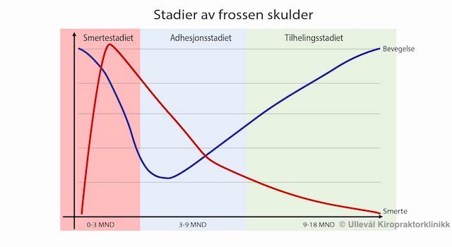 Illustrasjon av stadier og de forskjellige fasene ved frossen skulder