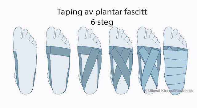 illustrasjon av hvordan man taper for plantar fascitt