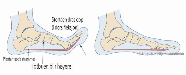 hvordan plantar fascia senen strammes opp ved løft av stortå