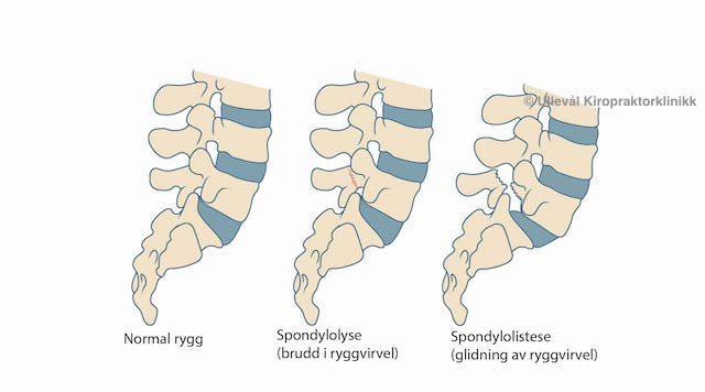 illustrasjon av spondylolistese og spondylolyse
