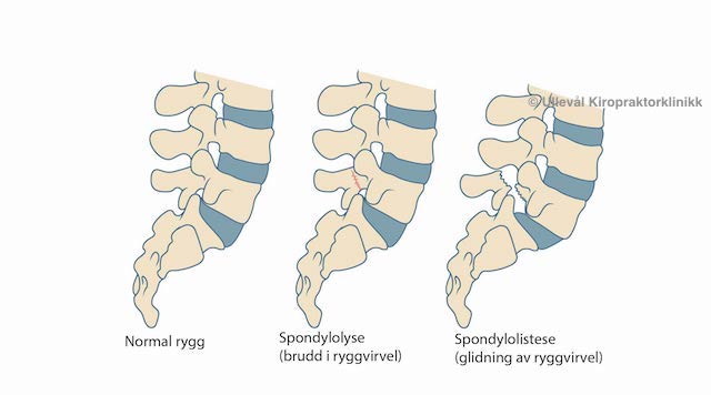 spondylolistese i korsryggen