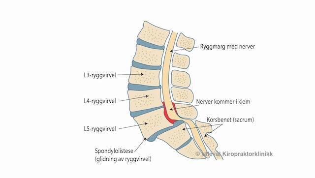 spondylolistese som klemmer på nerven