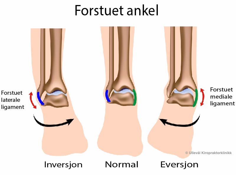 Forstuet Ankel Alt Du Trenger A Vite Ulleval Kiropraktorklinikk