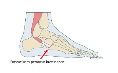 Image: Peroneal tendinopati - senebetennelse i ankelen