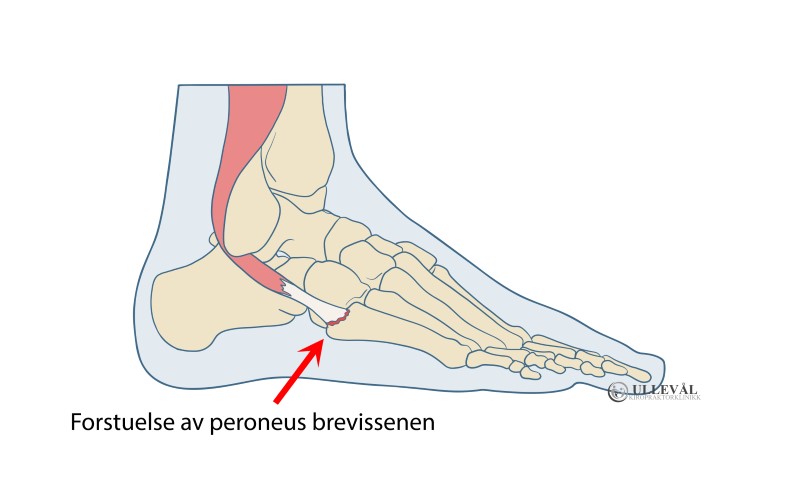 illustrasjon av peroneal tendinopati