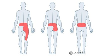 Image: Stor Guide om piriformissyndrom