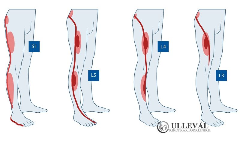 smerter og sensibilitetsendringer ved isjias - viser dermatomområdene i bena