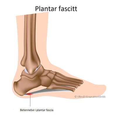 Image: Øvelser for plantar fascitt