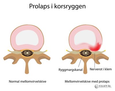 Image: Vanlige spørsmål om prolaps i korsryggen