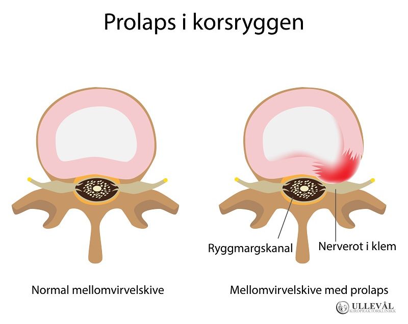 prolaps i korsryggen