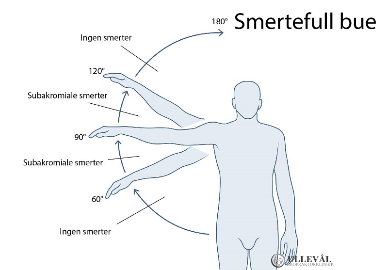 illustrasjon av smertefull bue ved skulderimpingement test