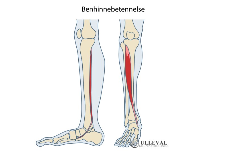 illustrasjon av lokasjon for beinhinnebetennelse