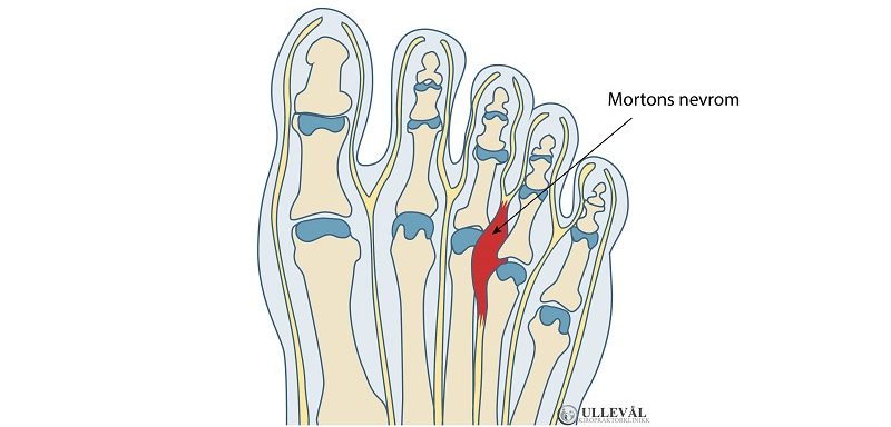 illustrasjon av mortons nevrom