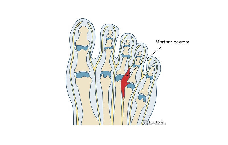 illustrasjon av mortons nevrom