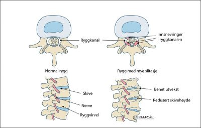 Image: Hva er spinal stenose?