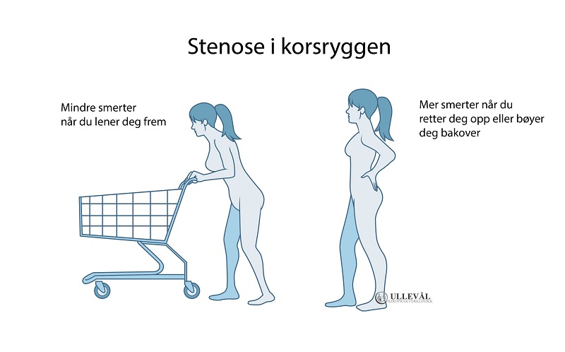 stenose i ryggen - bøyer seg fremover for å avlaste