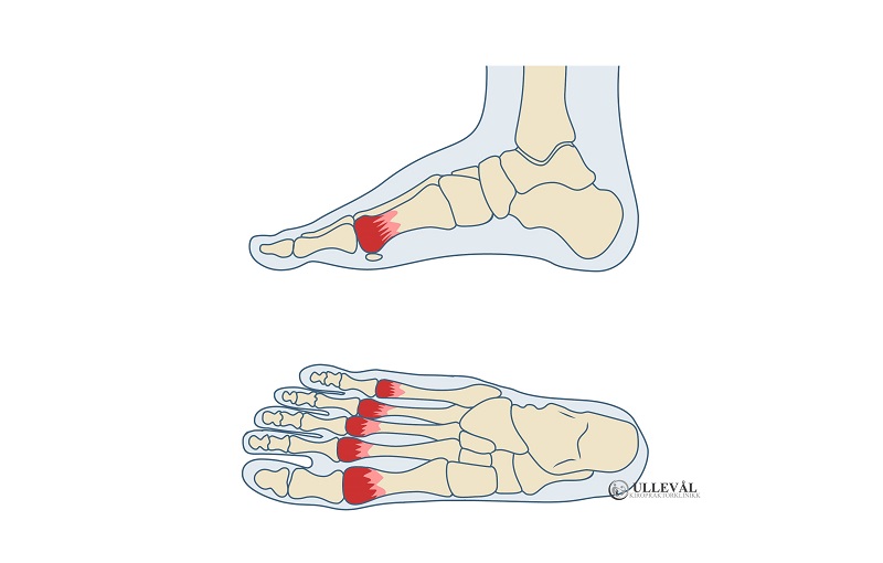 Smerter i flere forfotsben kalles metatarsalgi