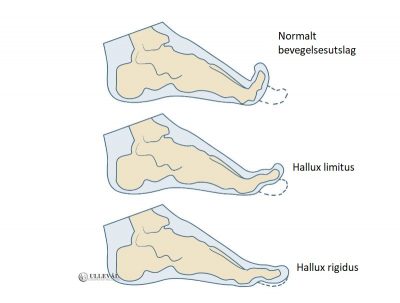 Image: Stivhet i stortå - Hallux limitus og rigidus