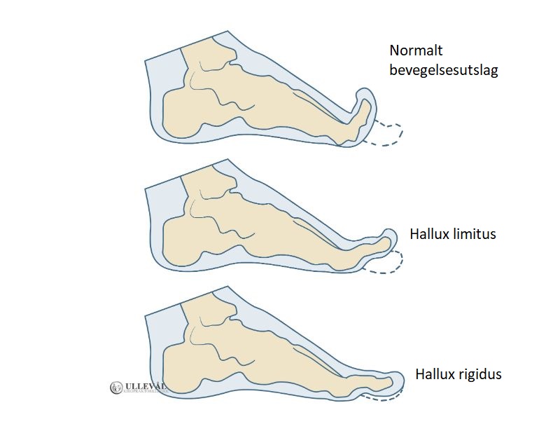 stivhet i stortå - halux limitus og rigidus illustrert